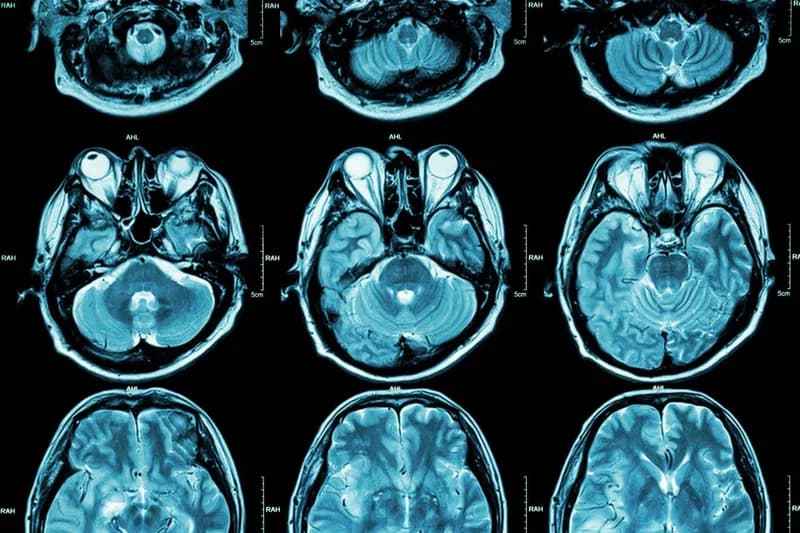 Autism Identified as Two Distinct Subtypes Based on Brain Connectivity