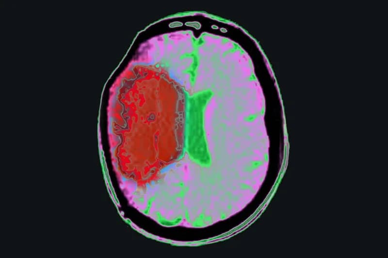 Drug-Induced Hypothermia May Protect Brain Cells After Stroke
