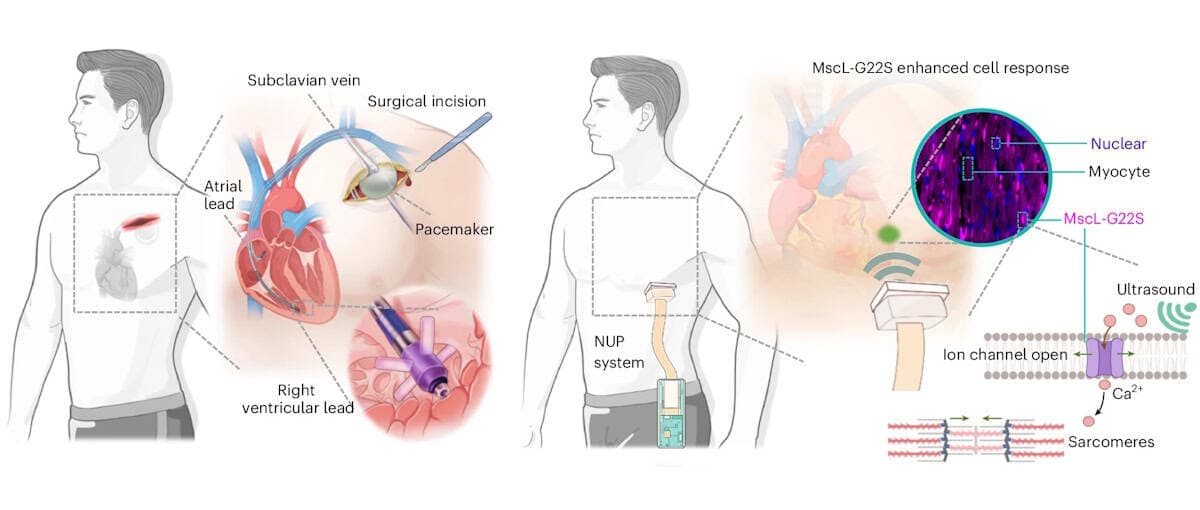Wearable Ultrasound Pacemaker Offers Non-Invasive Heart Rhythm Control