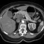 Investigational Therapy Shows Early Promise Against Advanced Pancreatic Cancer