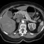 Terapie experimentală promițătoare împotriva cancerului pancreatic avansat