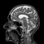 AI Reveals Hidden Brain Lesions in Multiple Sclerosis Using Legacy MRI Scans