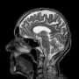 AI Reveals Hidden Brain Lesions in Multiple Sclerosis Using Legacy MRI Scans