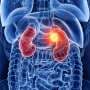 Combination Therapy Shows Promise in Fighting Renal Cell Carcinoma
