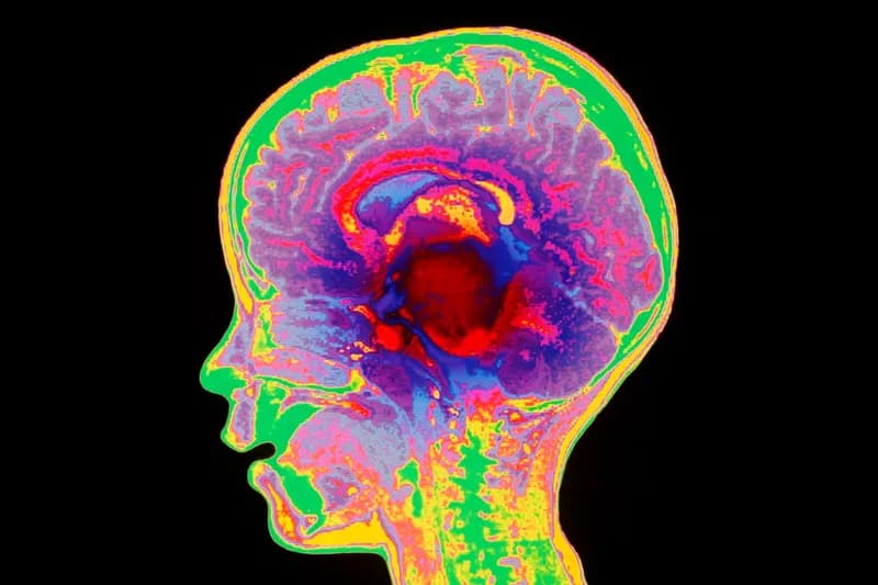 Experimental Cell Therapy Shows Breakthrough Results in Pediatric Brain Cancer