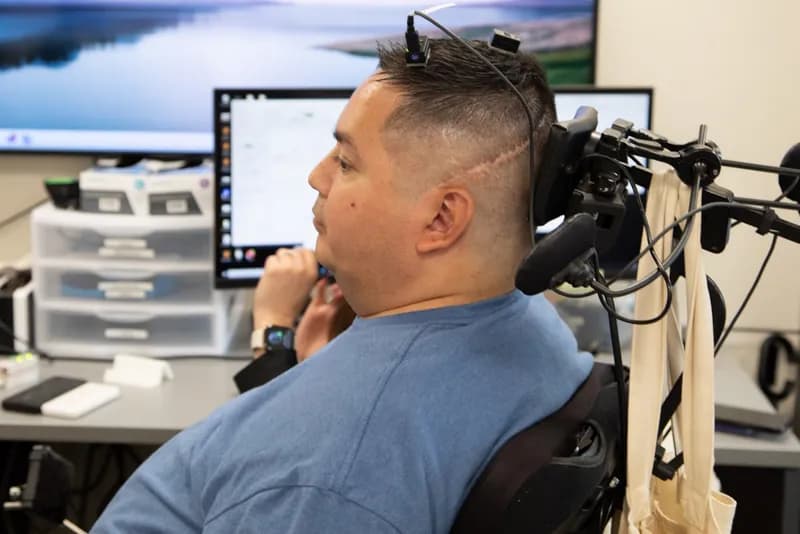 Neurostimulation Restores Long-Term Sensation in Paralyzed Hands