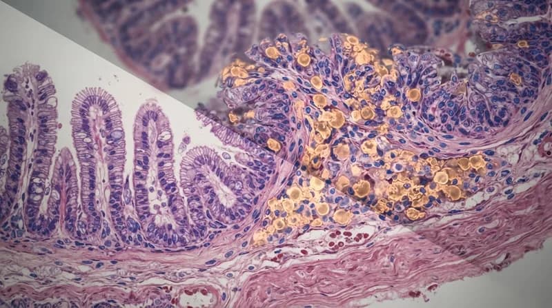 Unmasking 'Invisible' Inflammation: A Breakthrough in Bowel Disease and Cancer Risk